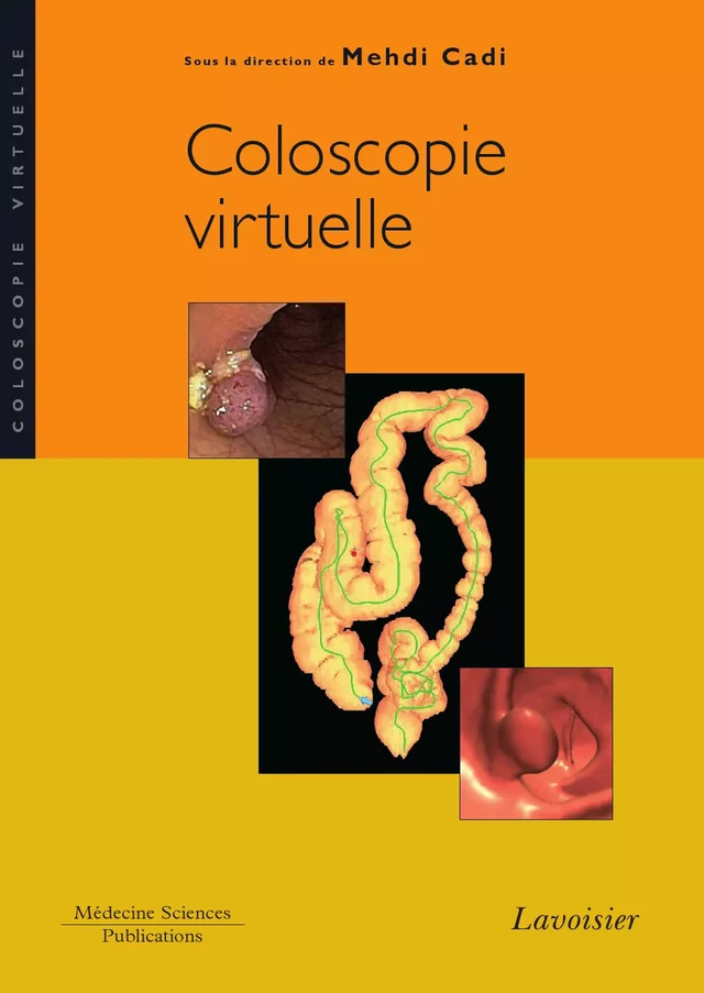 Coloscopie virtuelle - Mehdi Cadi - Médecine Sciences Publications