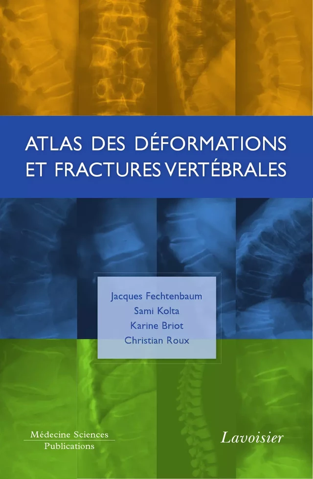 Atlas des déformations et fractures vertébrales - Jacques Fechtenbaum, Sami Kolta, Karine Briot, Christian Roux - Médecine Sciences Publications
